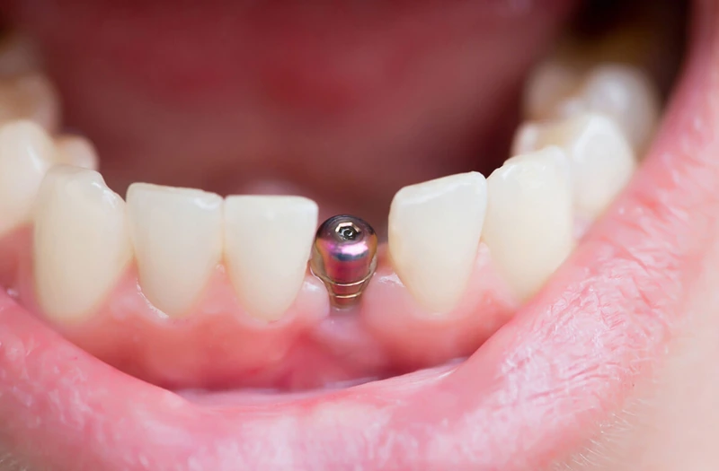 Implante dentário instalado entre dois dentes naturais